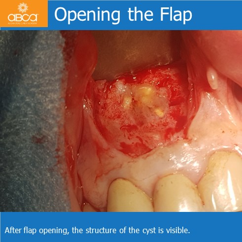 Large Cyst of the Front Right Maxilla