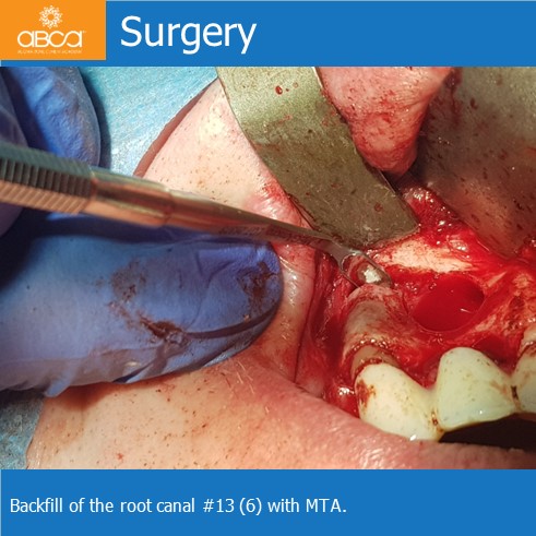 Cyst of the Right Maxilla and Prosthetic Restoration