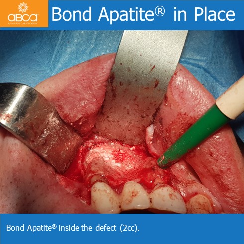 Cyst of the Right Maxilla and Prosthetic Restoration