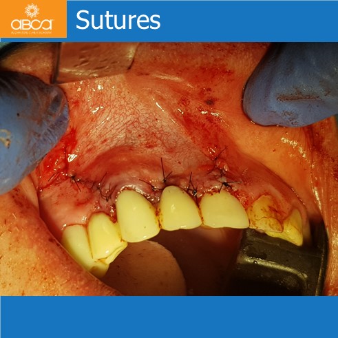 Cyst of the Right Maxilla and Prosthetic Restoration