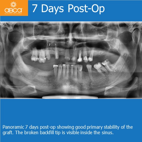 Cyst of the Right Maxilla and Prosthetic Restoration