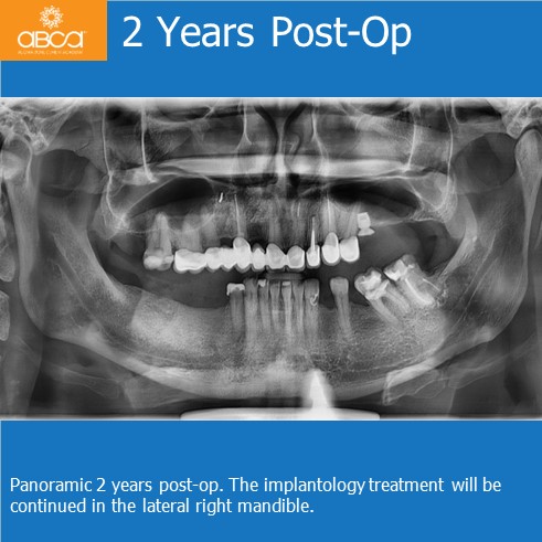 Cyst of the Right Maxilla and Prosthetic Restoration