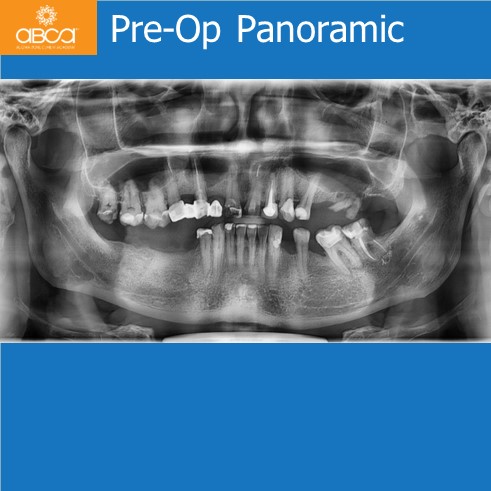 Cyst of the Right Maxilla and Prosthetic Restoration