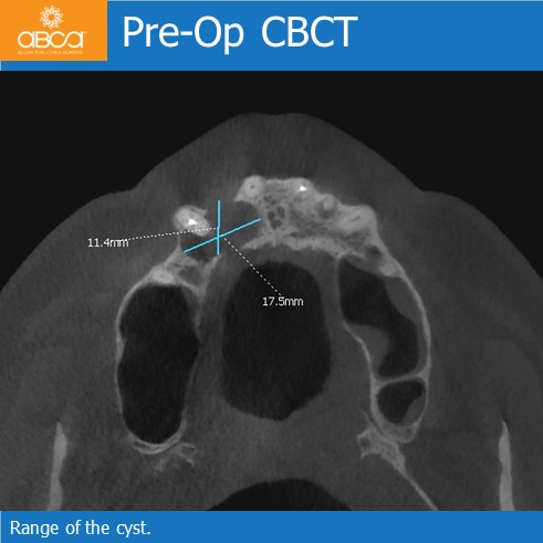 Cyst of the Right Maxilla and Prosthetic Restoration