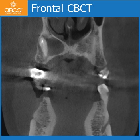 Cyst of the Right Maxilla and Prosthetic Restoration