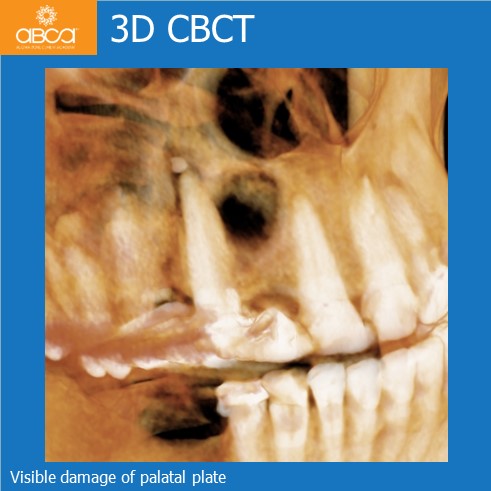 Cyst of the Right Maxilla and Prosthetic Restoration