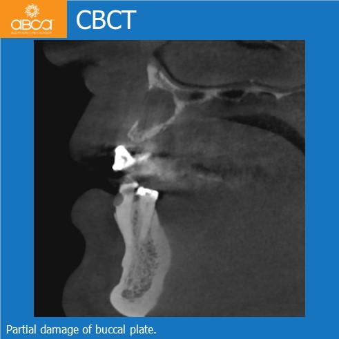 Cyst of the Right Maxilla and Prosthetic Restoration