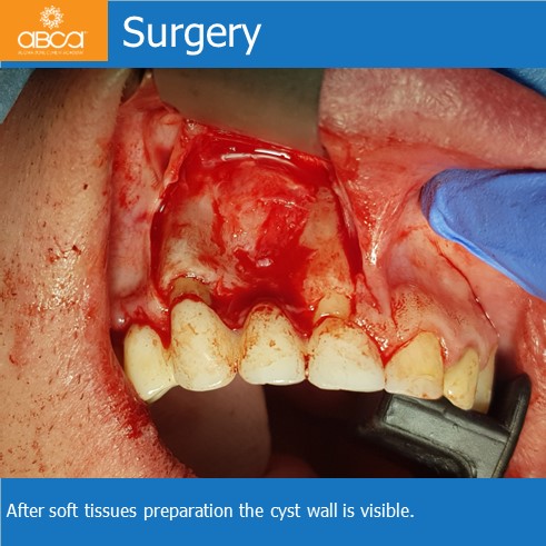 Cyst of the Right Maxilla and Prosthetic Restoration