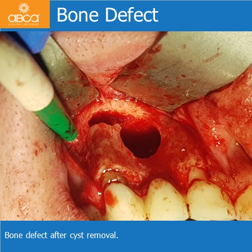 Cyst of the Right Maxilla and Prosthetic Restoration