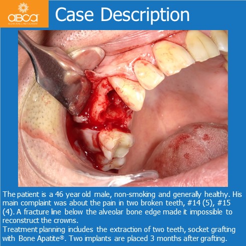 Preservation of Alveolar Socket using Bond Apatite