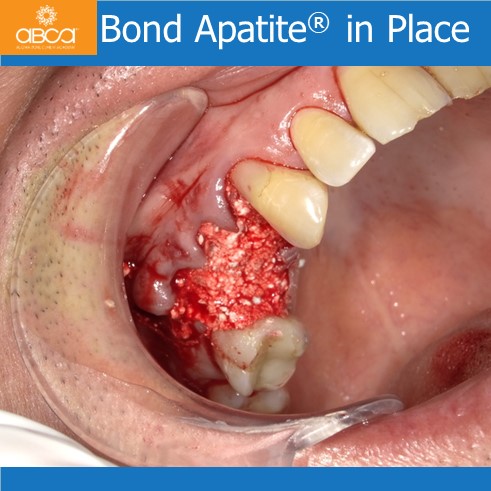 Preservation of Alveolar Socket using Bond Apatite