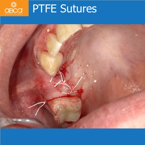 Preservation of Alveolar Socket using Bond Apatite