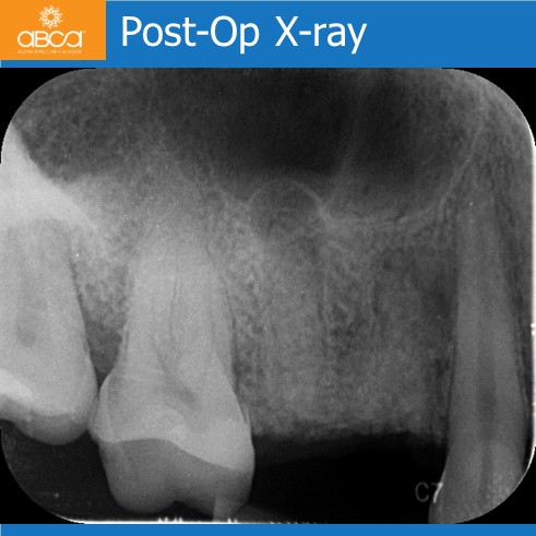 Preservation of Alveolar Socket using Bond Apatite