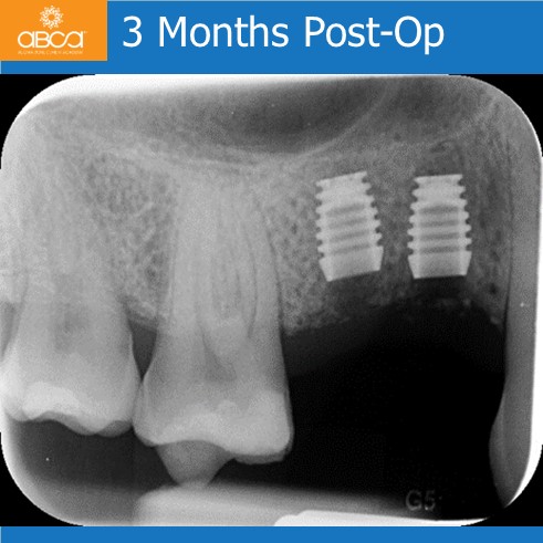 Preservation of Alveolar Socket using Bond Apatite