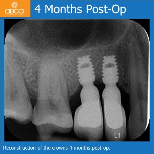 Preservation of Alveolar Socket using Bond Apatite