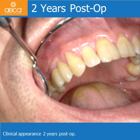 Preservation of Alveolar Socket using Bond Apatite