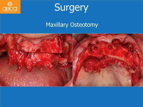 Maxilla and Mandible Total Rehabilitation