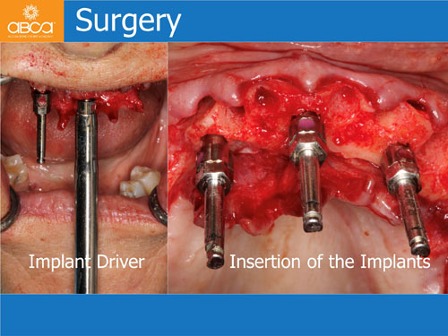 Maxilla and Mandible Total Rehabilitation