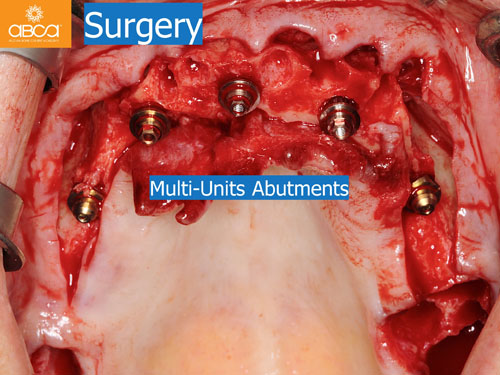 Maxilla and Mandible Total Rehabilitation