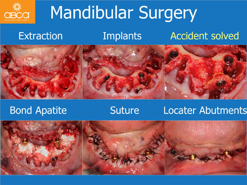 Maxilla and Mandible Total Rehabilitation