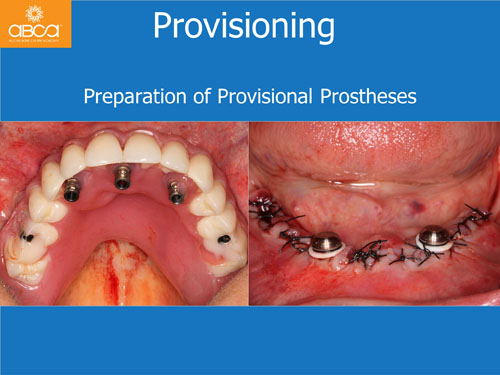 Maxilla and Mandible Total Rehabilitation