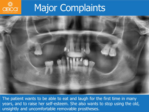 Maxilla and Mandible Total Rehabilitation