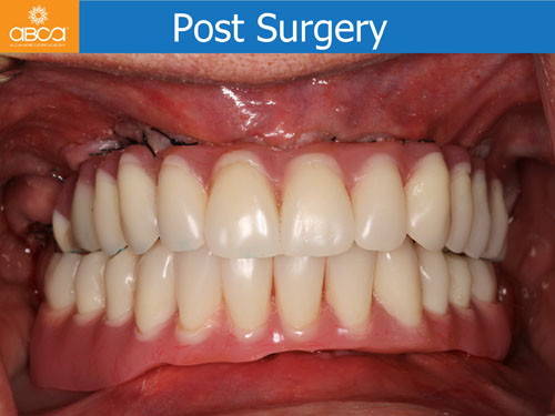 Maxilla and Mandible Total Rehabilitation