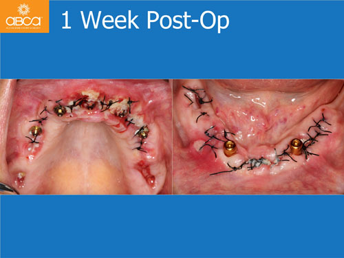 Maxilla and Mandible Total Rehabilitation