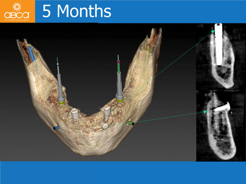 Maxilla and Mandible Total Rehabilitation