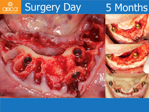 Maxilla and Mandible Total Rehabilitation