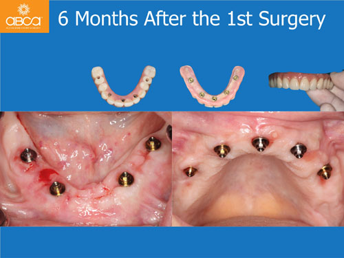 Maxilla and Mandible Total Rehabilitation