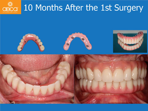Maxilla and Mandible Total Rehabilitation