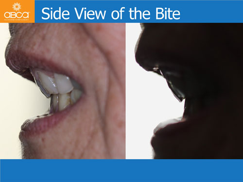 Maxilla and Mandible Total Rehabilitation