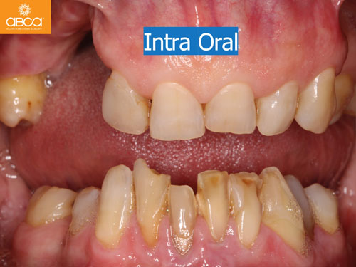 Maxilla and Mandible Total Rehabilitation