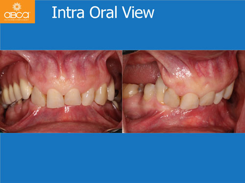 Maxilla and Mandible Total Rehabilitation