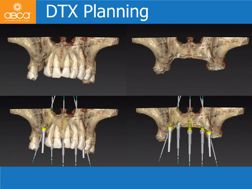 Maxilla and Mandible Total Rehabilitation