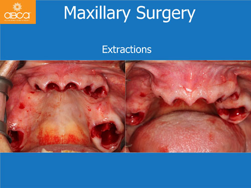 Maxilla and Mandible Total Rehabilitation