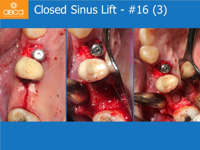 Immediate Loading in an Atrophied Maxilla