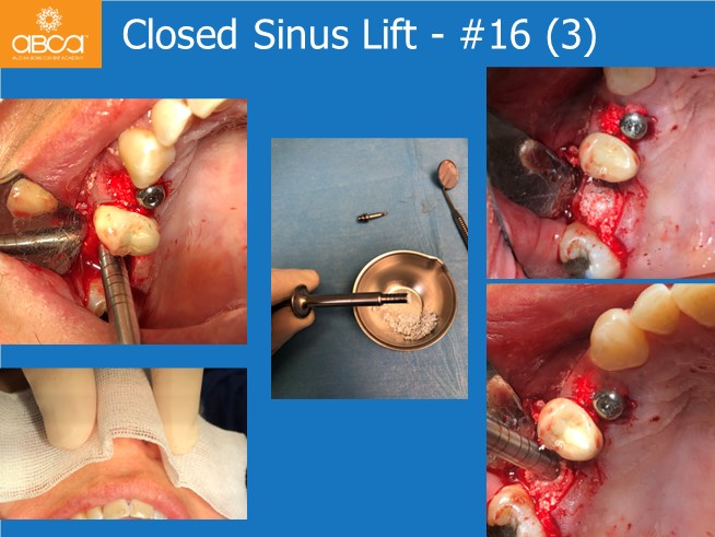 Immediate Loading in an Atrophied Maxilla