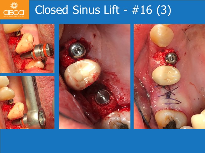 Immediate Loading in an Atrophied Maxilla