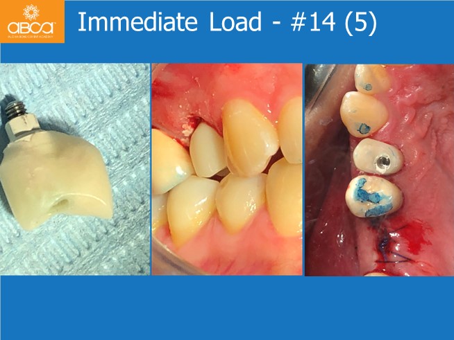 Immediate Loading in an Atrophied Maxilla