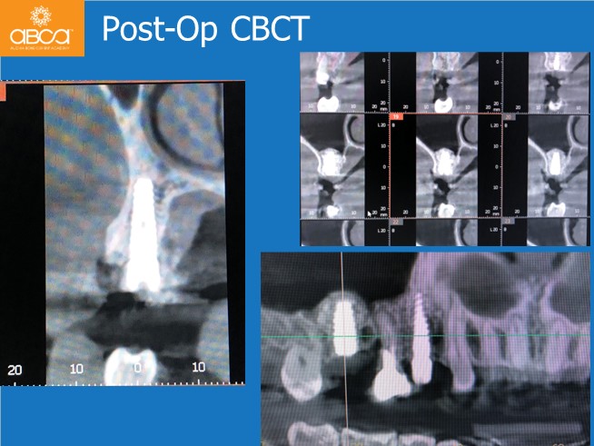 Immediate Loading in an Atrophied Maxilla