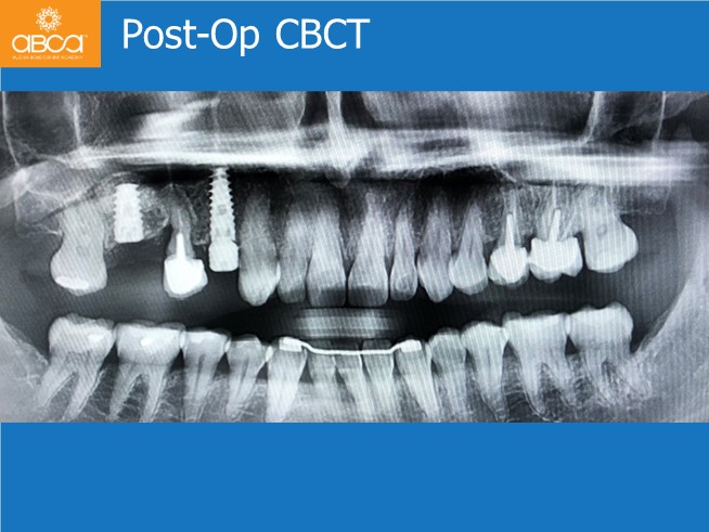 Immediate Loading in an Atrophied Maxilla