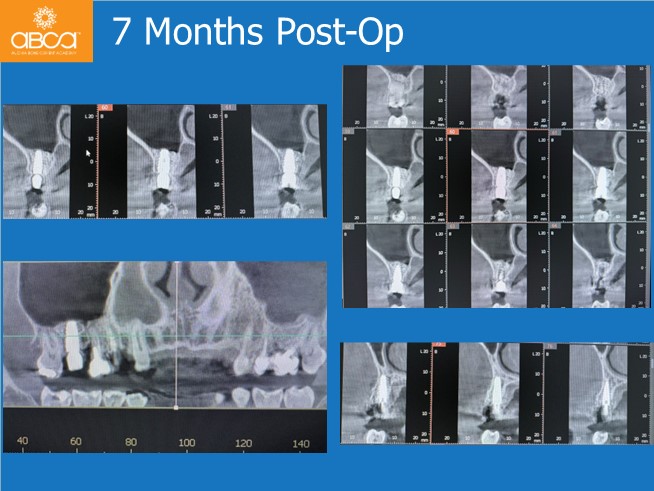 Immediate Loading in an Atrophied Maxilla