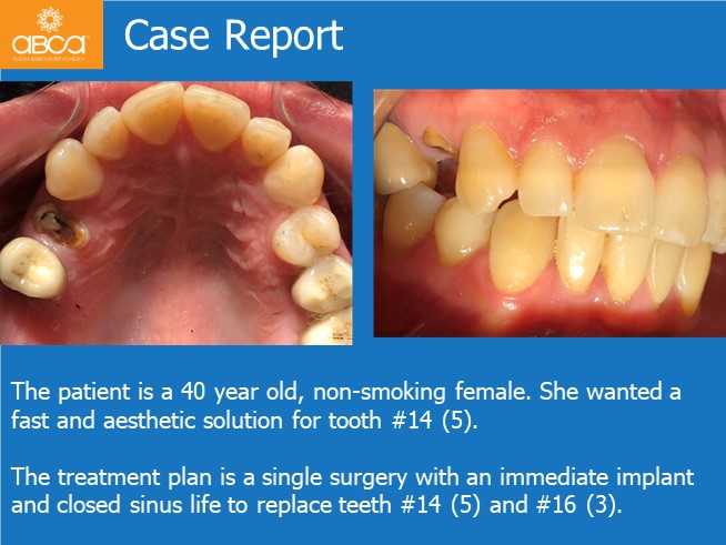 Immediate Loading in an Atrophied Maxilla