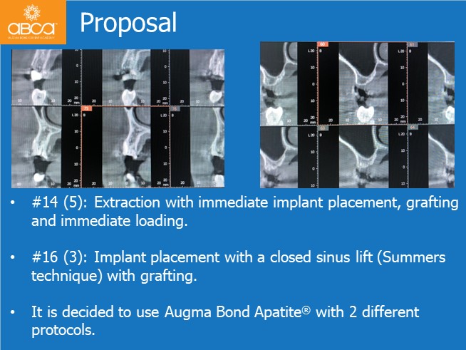 Immediate Loading in an Atrophied Maxilla