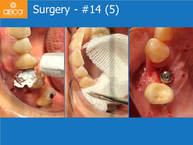 Immediate Loading in an Atrophied Maxilla