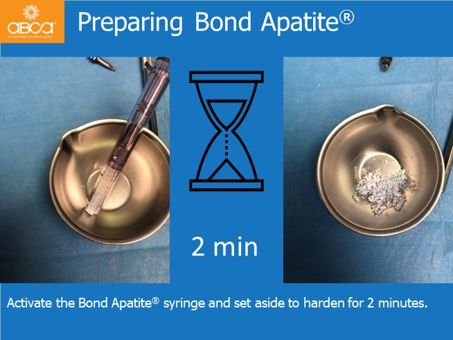 Immediate Loading in an Atrophied Maxilla