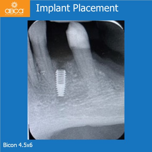 Implant Placement | Bicon 4.5x6