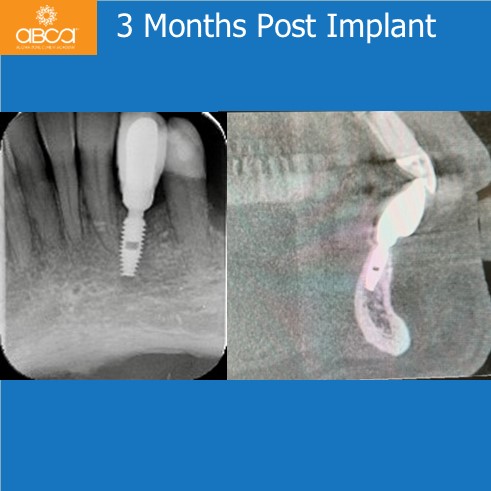 3 Months Post Implant